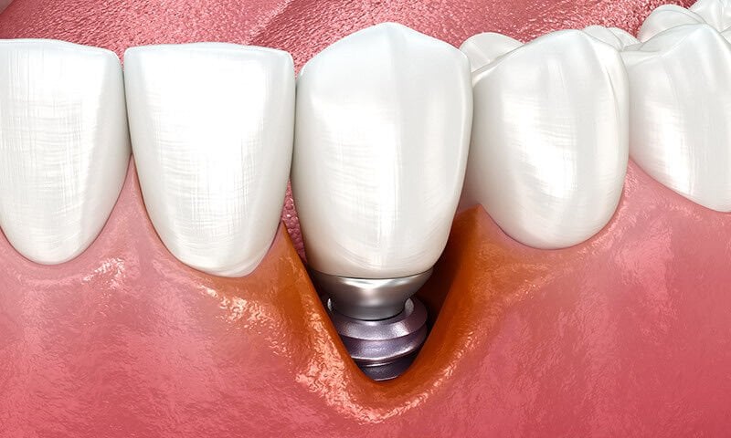 Peri-implantitis Nedir? Belirtileri, Nedenleri ve Tedavi Yöntemleri