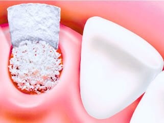 Kemik Grefti Nedir? - Kemik Grefti Hakkında Bilmen Gerekenler