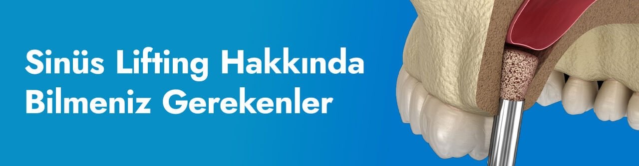 Sinüs Lifting Hakkında Bilmeniz Gerekenler