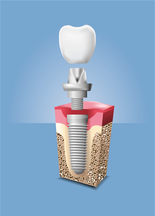 İmplant Nedir? Tüm Detaylarıyla Açıklıyoruz