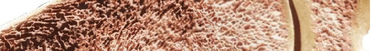 Modern Çene Cerrahisinde Greft Seçimi: Kanselöz veya Kortiko-Kanselöz