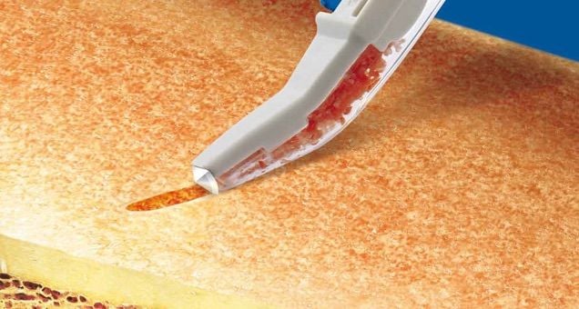 Otojen Greft Nedir? Nasıl ve nereden elde edilir?