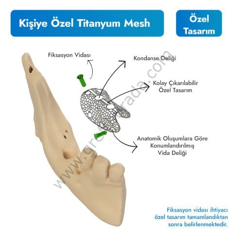 Kişiye Özel Titanyum Mesh