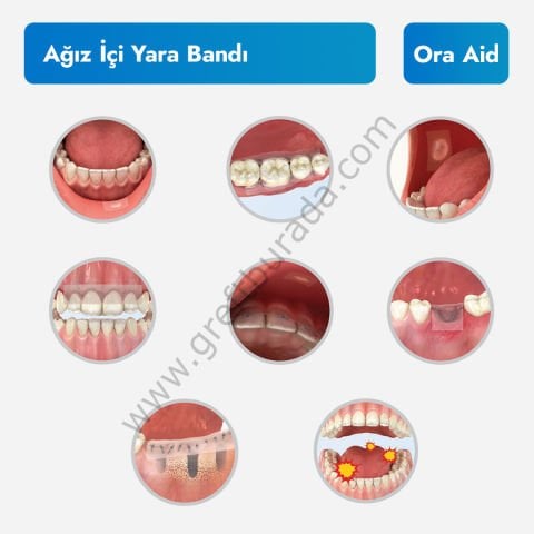 Ora Aid Ağız İçi Yara Bandı