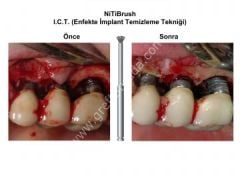 Niti Brush (Periimplantitis Fırçası/Frezi)
