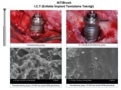 Niti Brush (Periimplantitis Fırçası/Frezi)