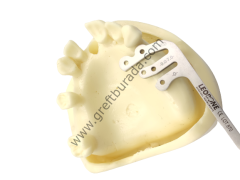 Leobone Implant Guide Kit (İmplant Konumlandırma Rehberi)