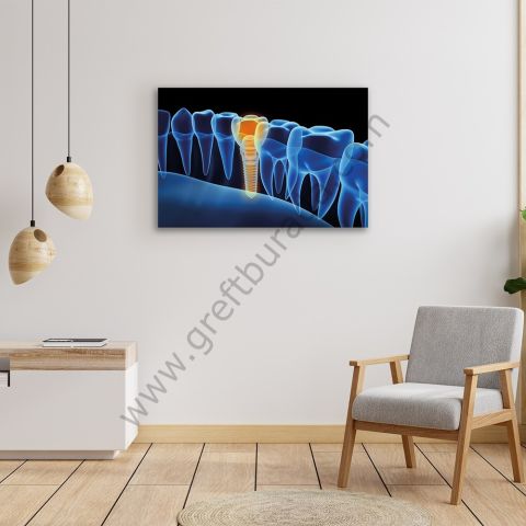 Dental Tablo - Implant 3d Black