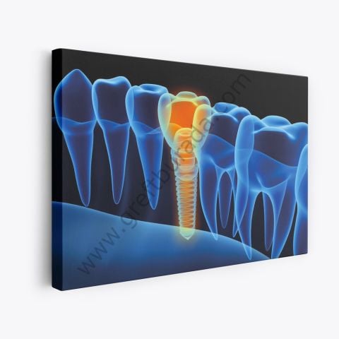 Dental Tablo - Implant 3d Black