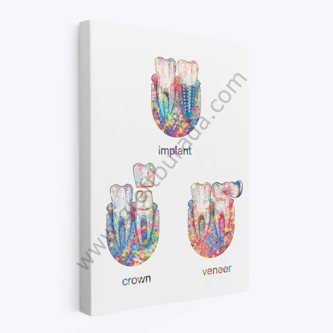 Dental -Tablo IMPLANT CROWN VENEER TABLO