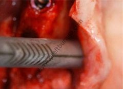 Meta Micross Kemik Kazıyıcı - Bone Scraper