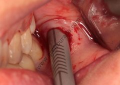 Meta Micross Kemik Kazıyıcı - Bone Scraper