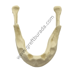 Defekte Mandibüla Çene Modeli